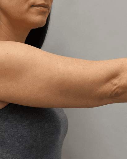 Full Arms: before