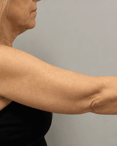 Full Arms: after