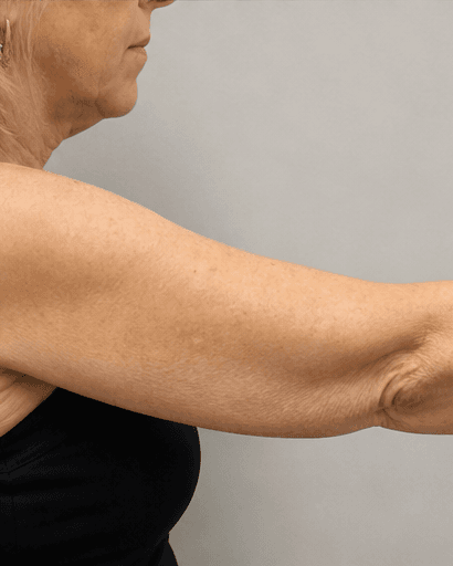 Full Arms: before