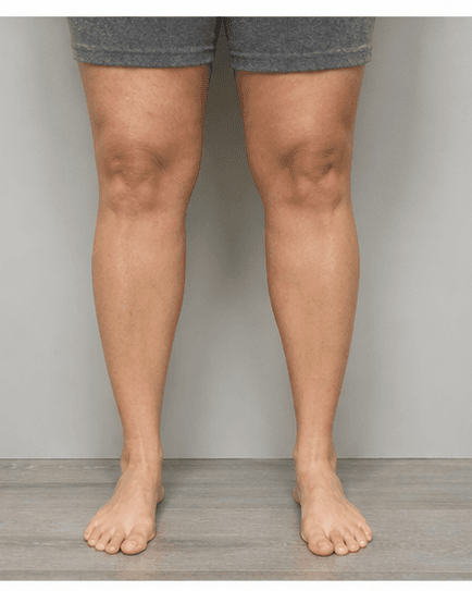 Full Legs: after