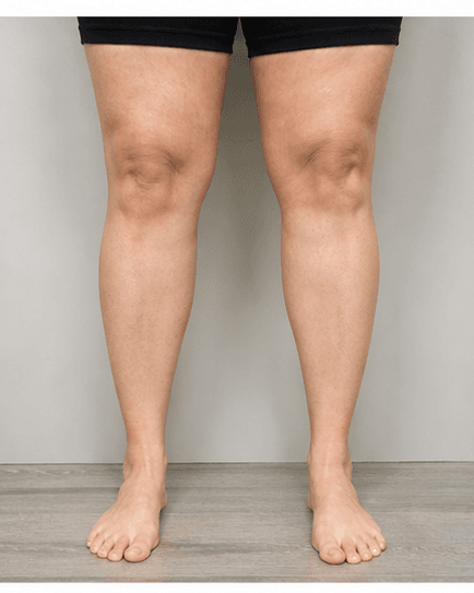 Full Legs: before