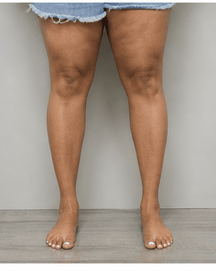 Full Legs: after
