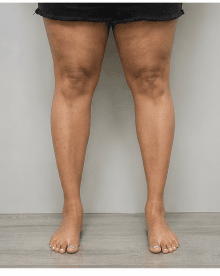 Full Legs: before
