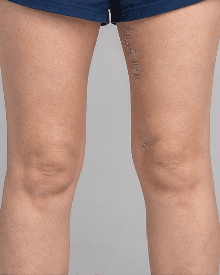 Full Legs: after