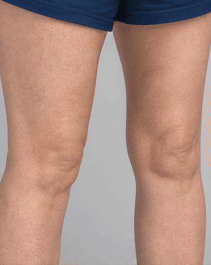 Full Legs: before