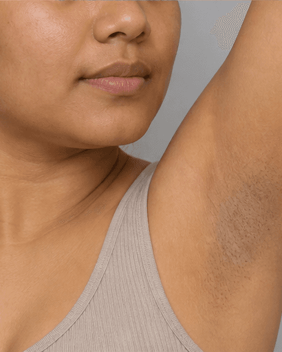 Underarms: before