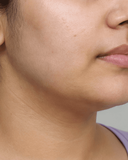 PCOS Facial Hair Programme: after