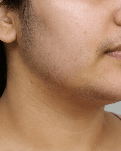 PCOS Facial Hair Programme: before