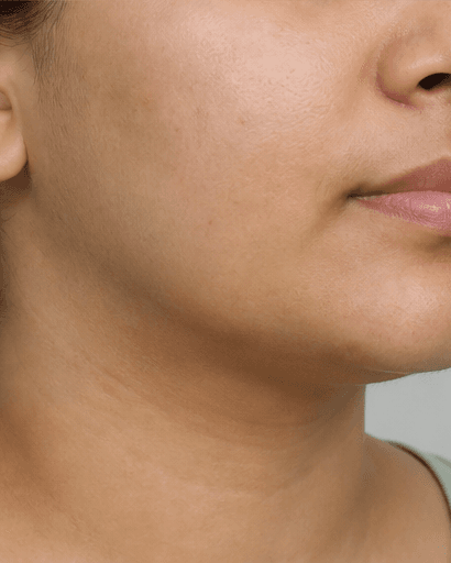 PCOS Facial Hair Programme: after