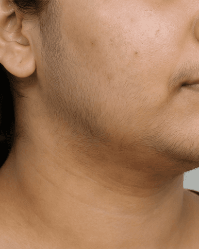 PCOS Facial Hair Programme: before