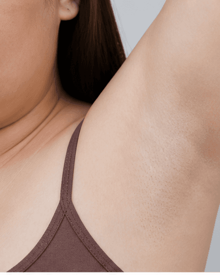 Underarms: after