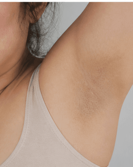Underarms: before