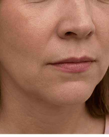 Upper Lip & Chin: after