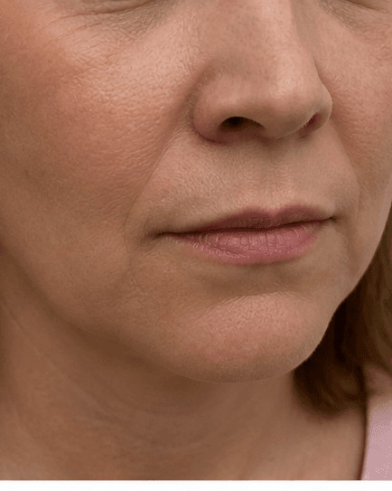 Upper Lip & Chin: before