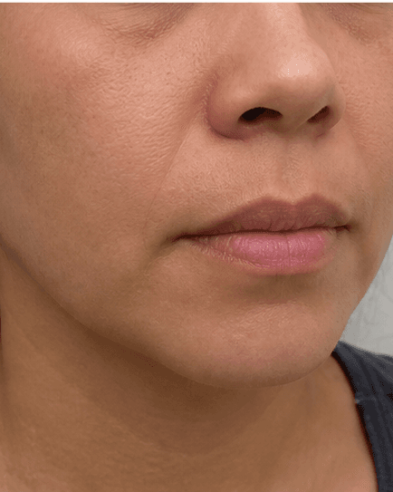 Upper Lip & Chin: after