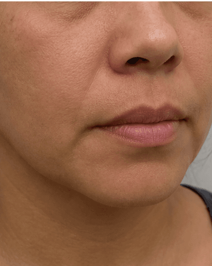 Upper Lip & Chin: before