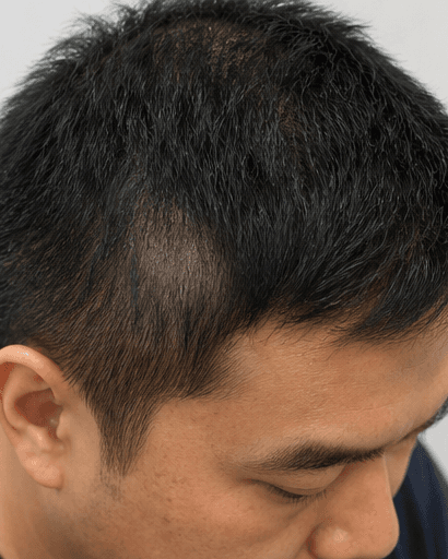 Alopecia Areata Treatment: after