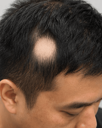Alopecia Areata Treatment: before