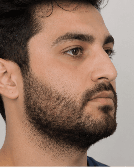 Beard Transplant: after