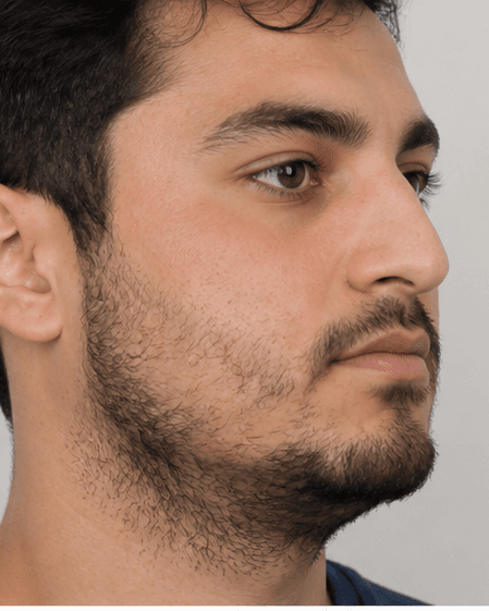 Beard Transplant: before