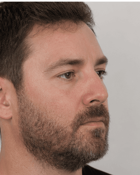 Beard Transplant: after