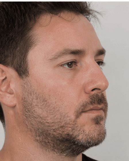 Beard Transplant: before