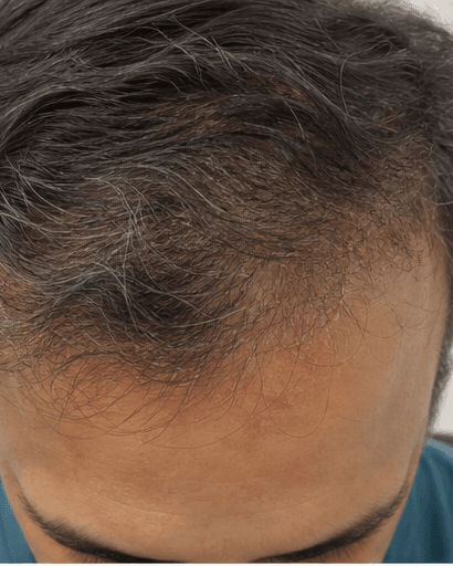 Seborrhoeic Dermatitis Care: after