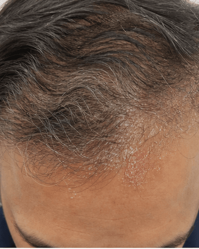 Seborrhoeic Dermatitis Care: before