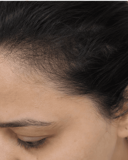 Seborrhoeic Dermatitis Care: after