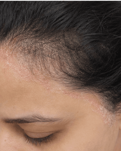 Seborrhoeic Dermatitis Care: before