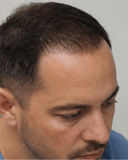 DHI Hair Transplant: after