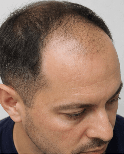DHI Hair Transplant: before