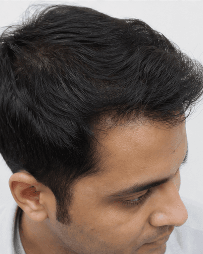 DHI Hair Transplant: after