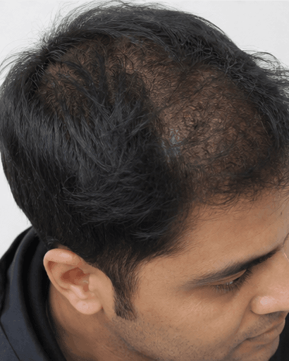 DHI Hair Transplant: before
