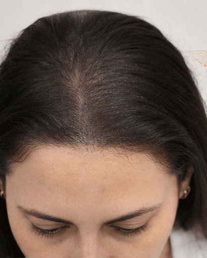 Exosome Scalp Therapy: after