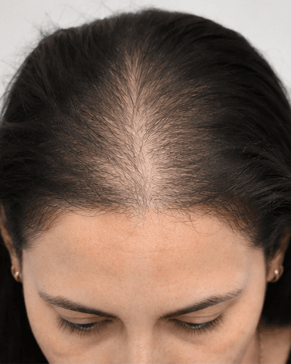 Exosome Scalp Therapy: before