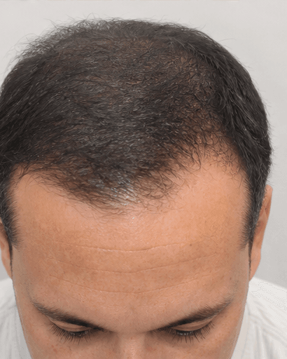 Exosome Scalp Therapy: after