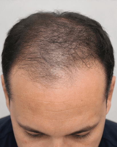 Exosome Scalp Therapy: before