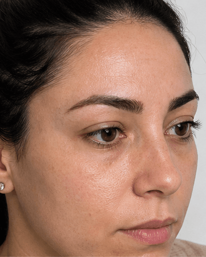 Eyebrow Transplant: after