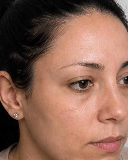 Eyebrow Transplant: before