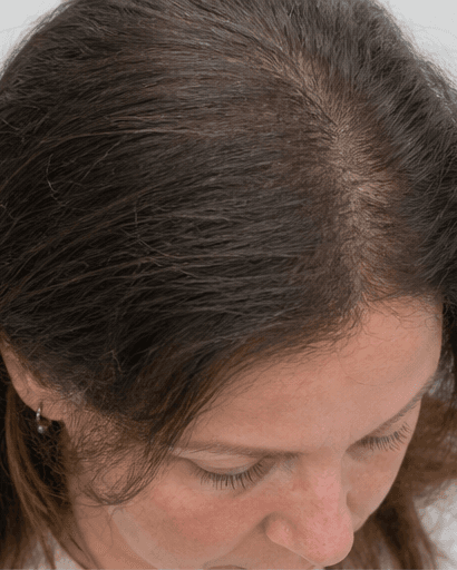 Female Pattern Hair Loss Programme: after