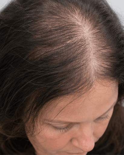 Female Pattern Hair Loss Programme: before
