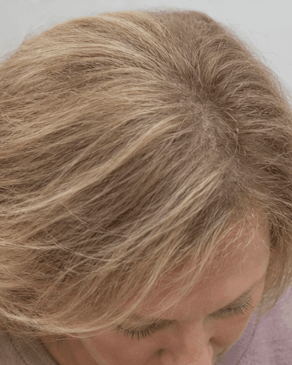 Female Pattern Hair Loss Programme: after