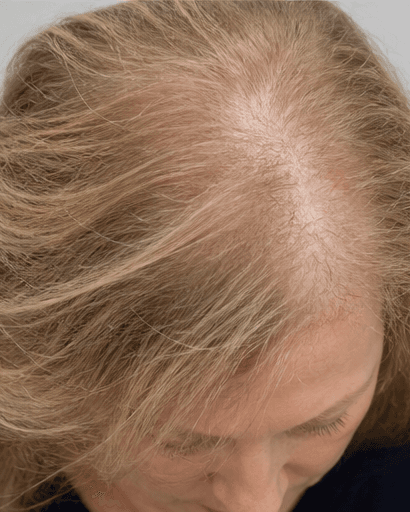 Female Pattern Hair Loss Programme: before