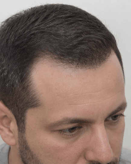 FUE Hair Transplant: after