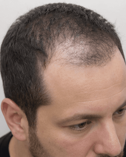 FUE Hair Transplant: before