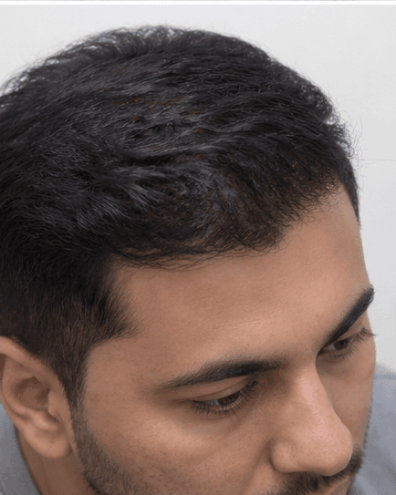 FUE Hair Transplant: after