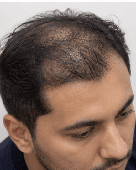 FUE Hair Transplant: before