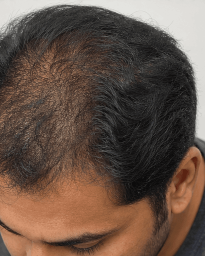 GFC Growth Factor: before