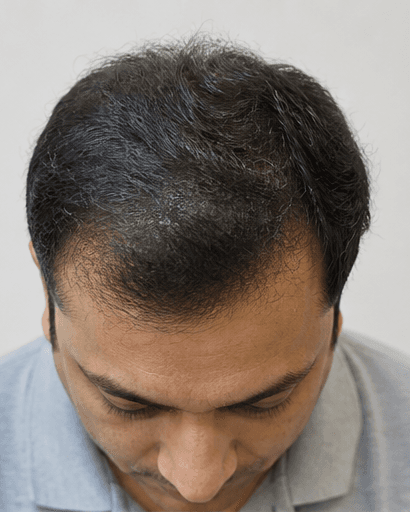 Hair Fall Diagnostics: after